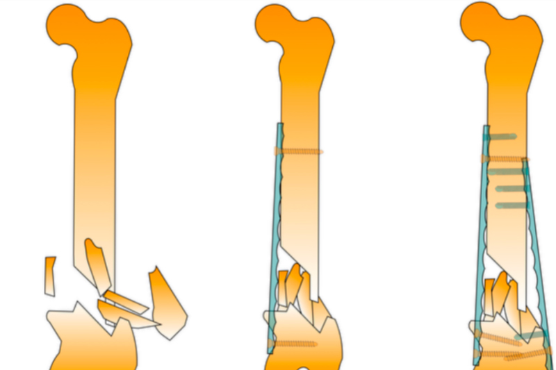 How to treat comminuted fractures of the distal femoral metaphysis in cats?