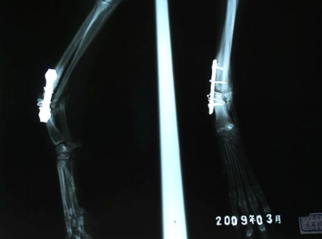 A case report of repair of secondary fracture of proximal metacarpal end of radius and ulna